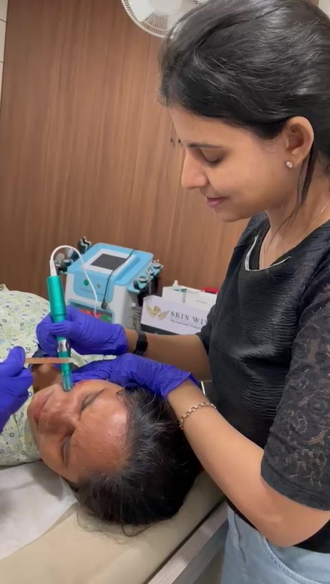 PRP with Microneedling for Acne Scars